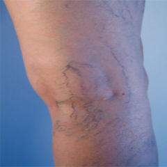 Signs You Need Varicose Veins Removal