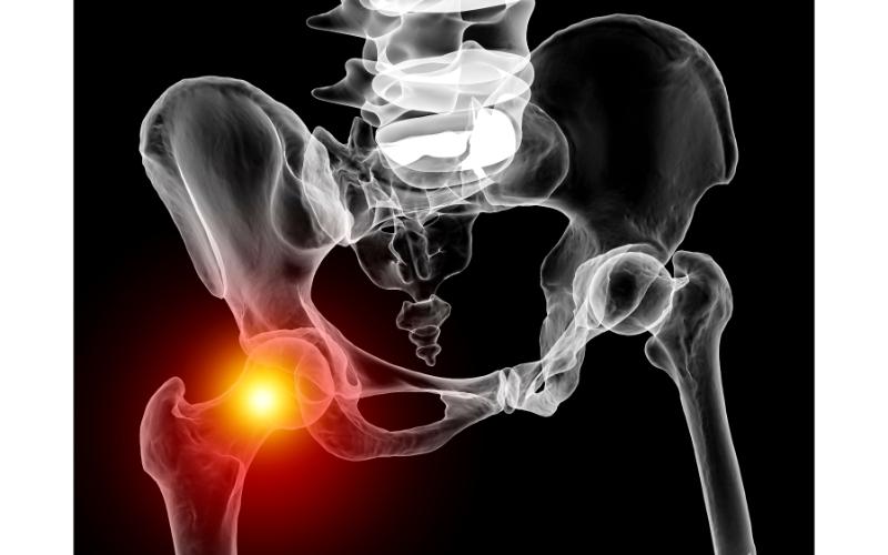 Hip Pain in New Haven, CT: How to Avoid Surgery While Seeking Treatment